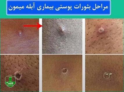 اگر این علائم را داشتید بدانید آبله میمونی گرفتهاید / این تغییرات پوستی را جدید بگیرید
