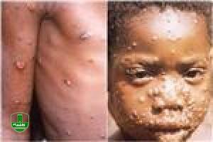 تفاوتهای آبله مرغان با آبله میمونی