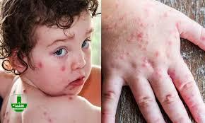 شیوع «تب گوجه فرنگی» ، علائم این بیماری چیست؟