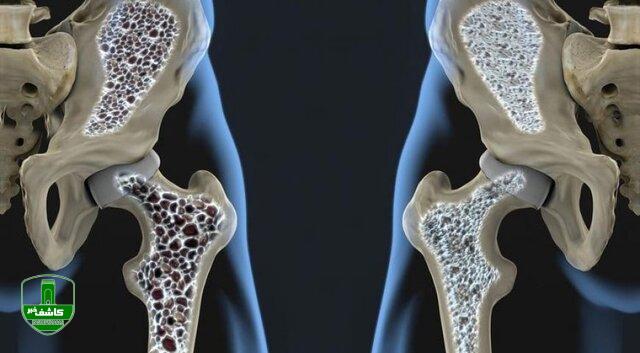 افزایش ابتلا به پوکی استخوان در جهان/ ابتلای دوسوم زنان بالای ۶۰ سال ایران