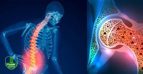 بروز پوکی استخوان در ۶۰ درصد ایرانیان بالای ۵۰ سال بروز پوکی استخوان در ۶۰ درصد ایرانیان بالای ۵۰ سال