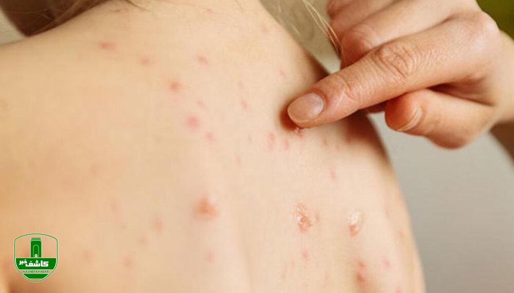 طغیان مسریترین ویروس جهان؛ افزایش ۴۰ درصدی مرگ و میر ناشی از این بیماری