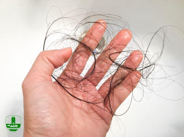 ویتامینی که از ریزش مو جلوگیری میکند ویتامینی که از ریزش مو جلوگیری میکند