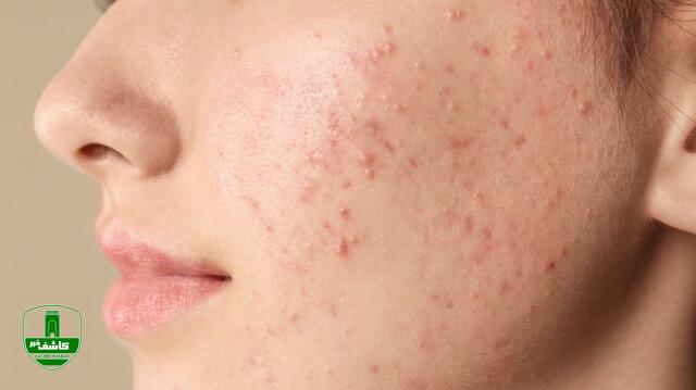 چرا جوش میزنیم؟ چرا جوش میزنیم؟