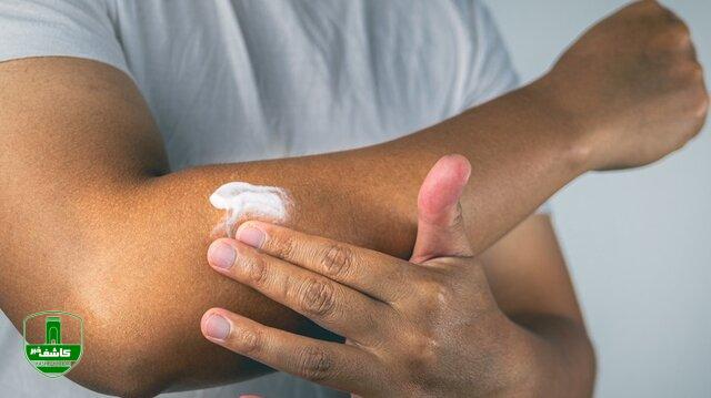 درمانهای طبیعیِ آفتاب سوختگی؛ از ژل خالص آلوئه ورا تا مخلوط شیر و زردچوبه