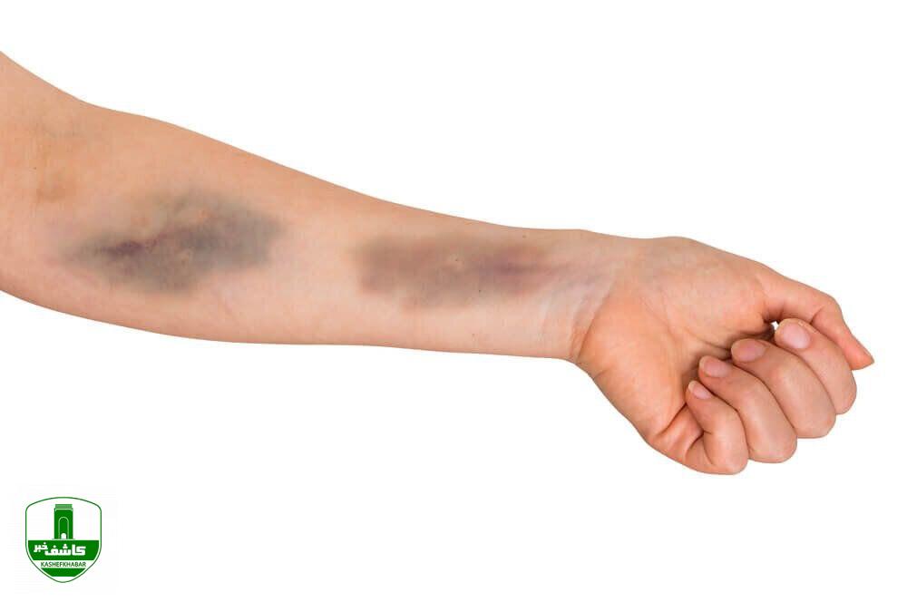 بدن شما هم بیدلیل کبود میشود؟